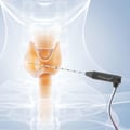Can Radiofrequency Ablation Treat Thyroid Cancer?